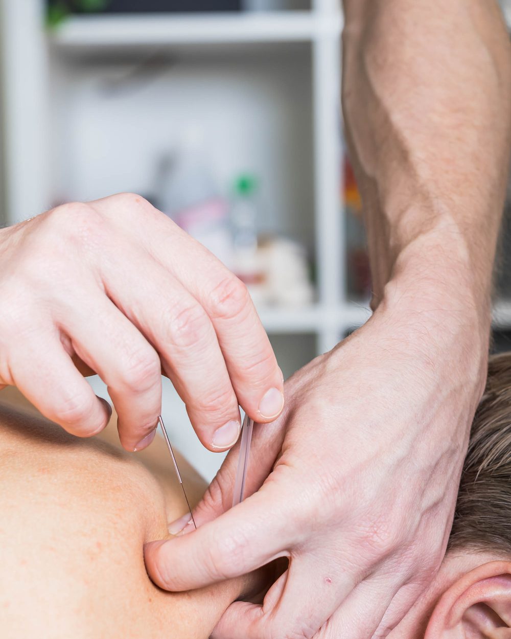Dry needling av nakke- og skuldermuskulatur
